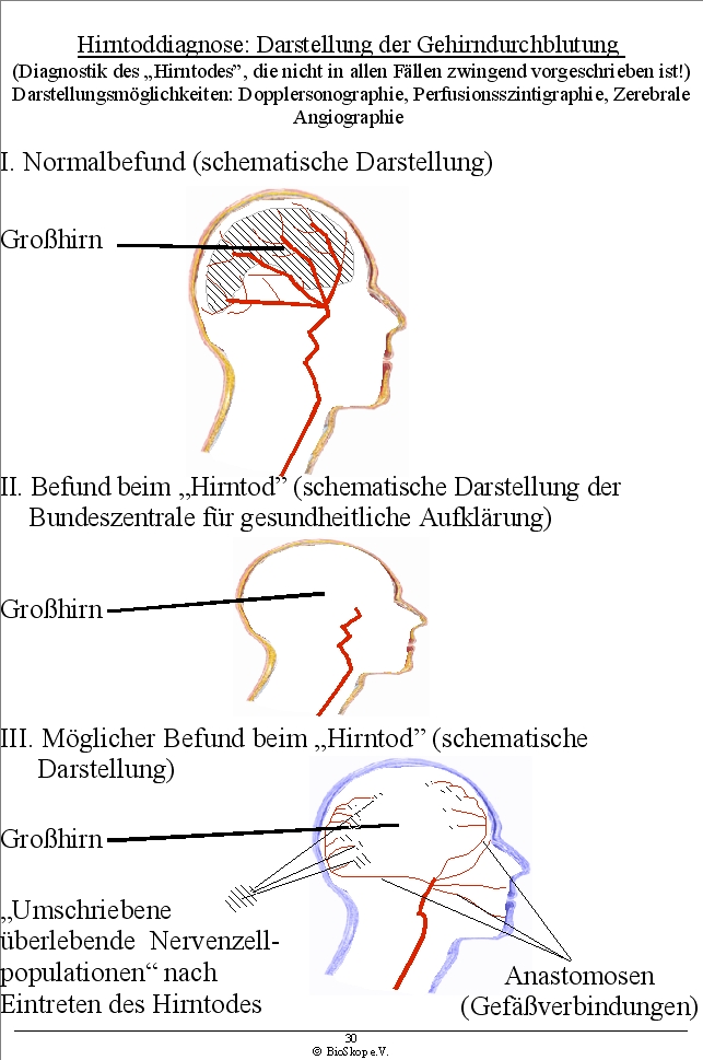 Hirntoddiagnostik: Darstellung er Gehirndurchblutung